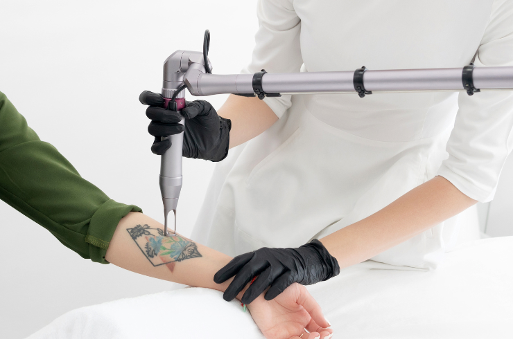 Tattoo Removal