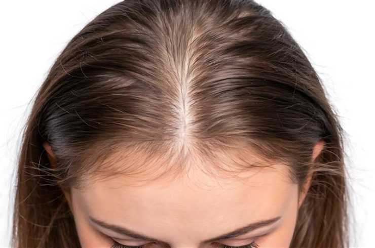 Female Pattern Hair Loss (FPHL)
