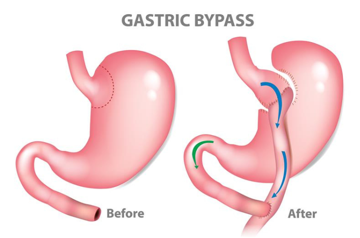 Bariatric Surgery
