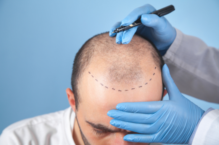 Hair Transplantation